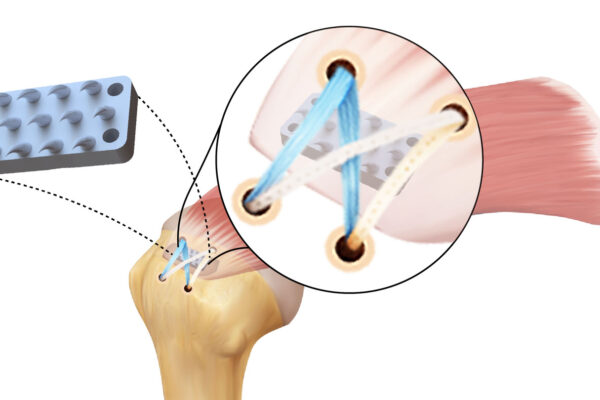 An illustrated diagram of the python-inspired device placed between the head of an arm bone and the tendon in the rotator cuff. The illustration features a closeup on the connection.