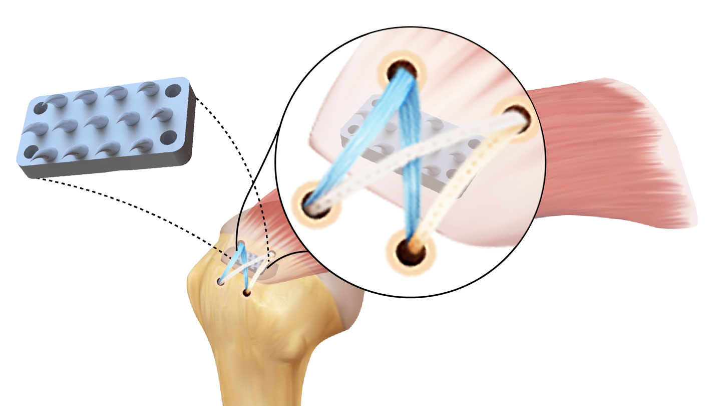 An illustrated diagram of the python-inspired device placed between the head of an arm bone and the tendon in the rotator cuff. The illustration features a closeup on the connection.